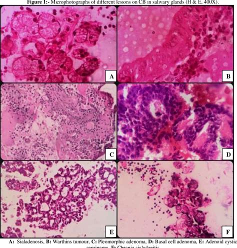 Figure 1 From COMPARATIVE STUDY OF FINE NEEDLE ASPIRATION AND CELL