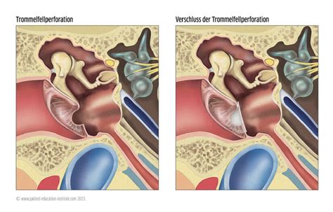 Wann Ist Einen Ohroperation Notwendig Hno Praxis Sarnen