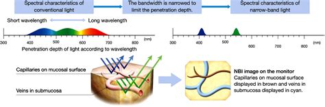 The Role Of Narrow Band Imaging In Early Detection Of Head And Neck Cancer British Journal Of