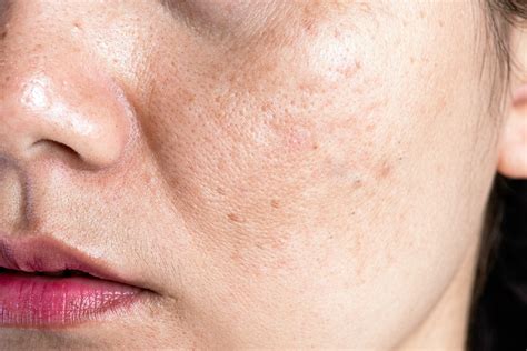 Saiba O Que Melasma E Conhe A Dicas Para Tratar