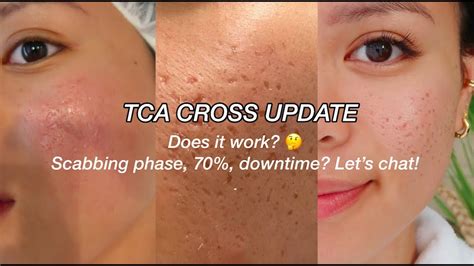 TCA CROSS UPDATE L ACNE SCARS YouTube