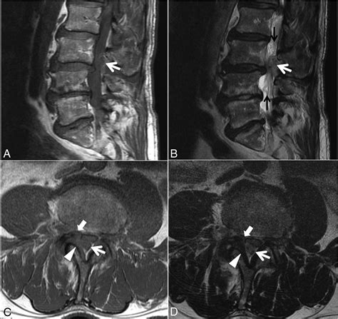 Bulging Disc L5 S1 Epidural