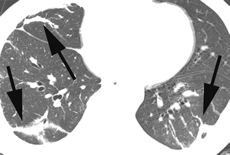 Eosinophilic Lung Diseases A Clinical Radiologic And Pathologic