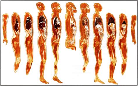 Polyester Plastination Of Biological Tissue Hoffen P45 Technique The