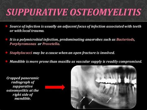 Osteomyelitis Of Jaw