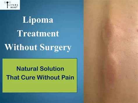 Ppt Discover A New Solution For Lipoma Treatment At Home Powerpoint