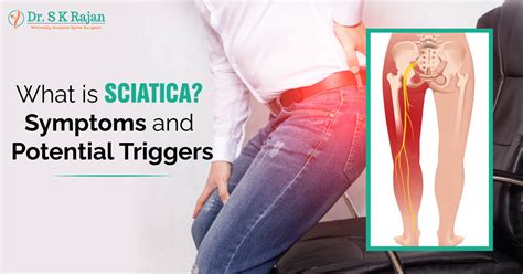 What Is Sciatica? Symptoms and Potential Triggers