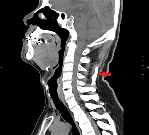 Ossification Of The Nuchal Ligament Bmj Case Reports