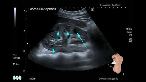 Glomerulonephritis Ultrasound