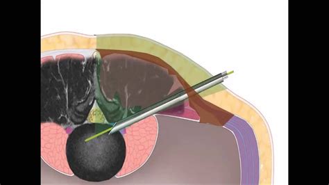 Percutaneous Endoscopic Transforaminal Lumbar Discectomy For Highly