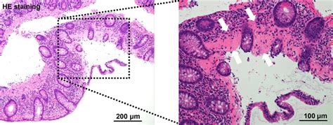 Histologic Pictures Hande Stain Of A Colonic Biopsy Specimen Showing Download Scientific