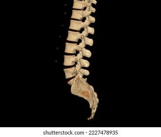 Ct Scan Lumbar Spine D Rendering Stock Illustration