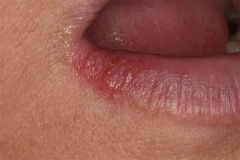 Cold Sores In Corner Of Mouth