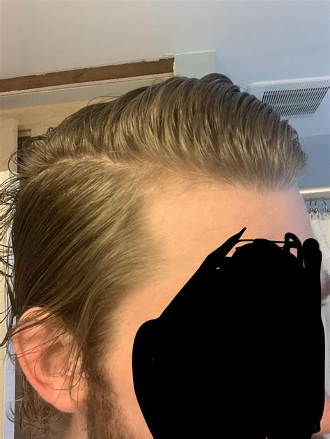 Topical Finasteride And Minoxidil 6 Months Results R Tressless