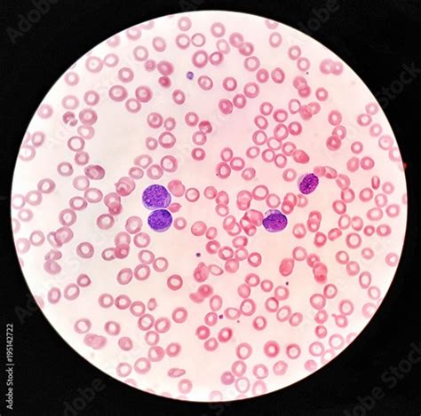 Blood Smear Under Microscope