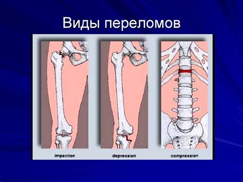 Переломы костей. Лечение переломов - презентация онлайн