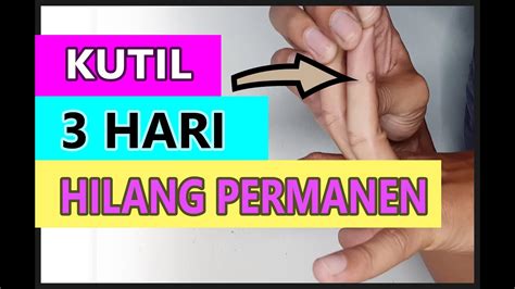 Cara Menghilangkan Kutil Secara Permanen Youtube