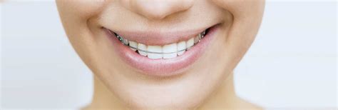 Retainers Keep Your Smile Beautiful Bothell Orthodontics