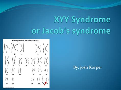 Jacob Syndrome Karyotype