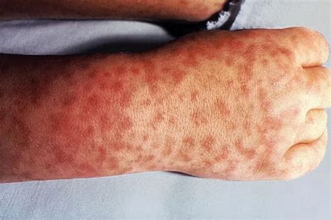 Life Threatening Skin Rashes