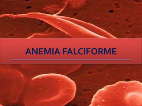 Sintomas Da Anemia Falciforme E Tratamentos Dicasfree