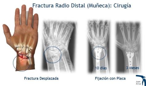 Fracturas de Muñeca y Mano en el Deporte Juan Arnal Traumatologo en