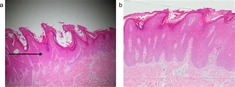 Histological Observations Of Lesional Skin Biopsy From Prurigo