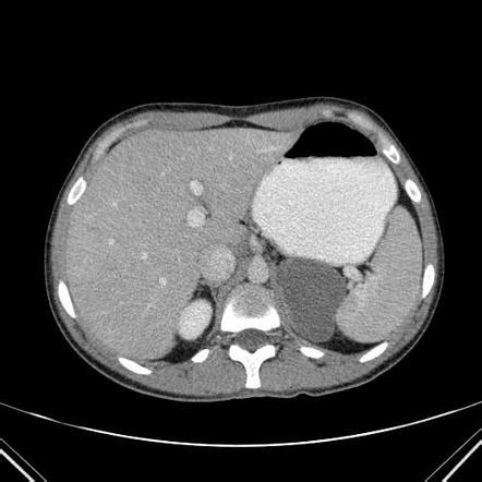 Gastric Duplication Cyst Radiology Case Radiopaedia Org