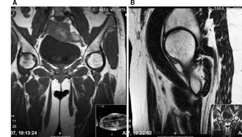 T Weighted A Coronal And B Sagittal Right Hip Mri Of The Hips