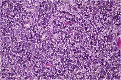 Sex Cord Stromal Tumors Of The Testis Diagnostic Histopathology