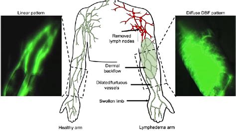 Schematic On Lymphedema And Example Indocyanine Green Mediated