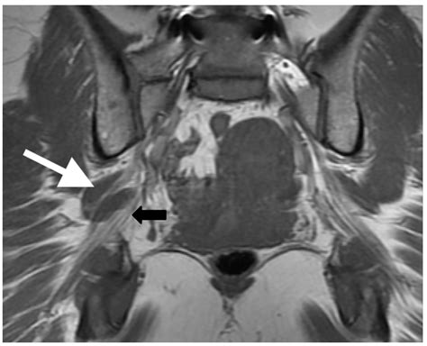 Piriformis Syndrome Mri