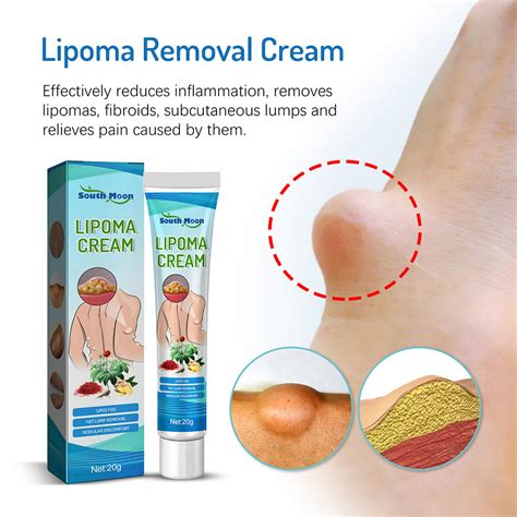 Lipoma Remove Cream Body Care Reduce Lipoma Fat Lumps Subcutaneous