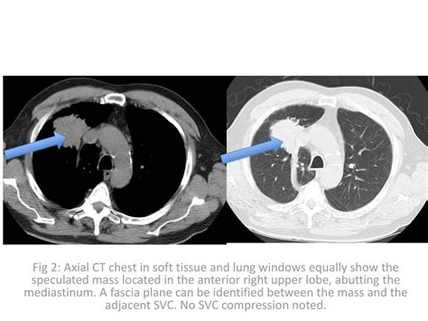 Fig 1 Pa Chest Radiograph Demonstrates A Large Well Defined Lobular Mass Projected In The Right