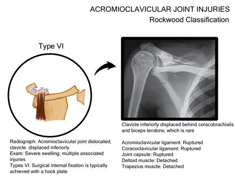 Acromioclavicular Joint Injuries Illustrations International Emergency Medicine Education Project