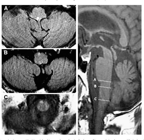 Figure 1 From Pure Ipsilateral Central Facial Palsy And Contralateral Hemiparesis Secondary To