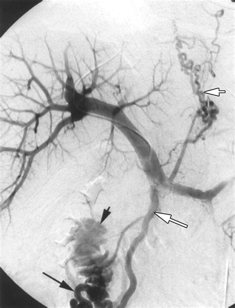 Detecting Bleeding Duodenal Varices With Multislice Helical CT AJR