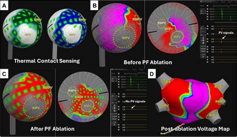 Af Ablation Using A Novel Single Shot Map And Ablate Spherical Array