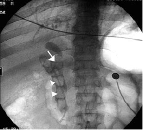 Cholangiogram Demonstrating Filling Defects In The Common Bile Duct Download Scientific Diagram