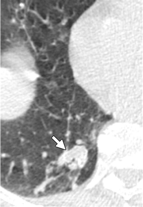 Amyloidosis Modern Cross Sectional Imaging Radiographics