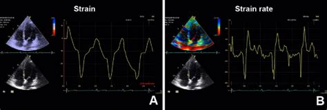 Tissue Doppler Imaging Derived Strain And Strain Rate Left Ventricular