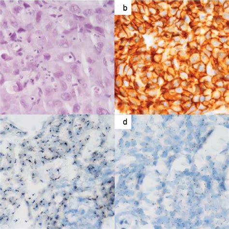 Poorly Differentiated Infiltrating Duct Breast Carcinoma With Her