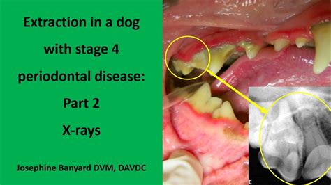 stage 4 periodontal disease Periodontal disease – pocono periodontics ...