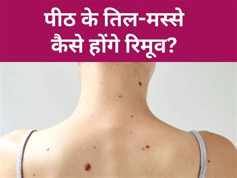 How To Remove Mole And Wart On Back Home Remedies Peeth Ki Til Aur