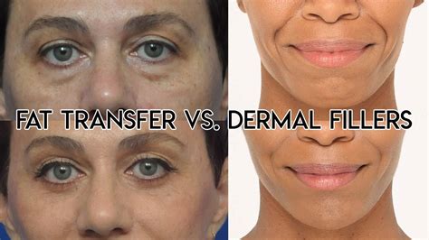 Fat Transfer Vs Dermal Filler Youtube