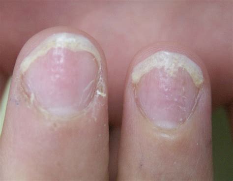 Le Psoriasis De L Ongle Reso Dermatologie