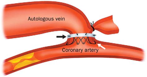 Sutureless Mechanical Anastomosis Of A Saphenous Vein Graft To A