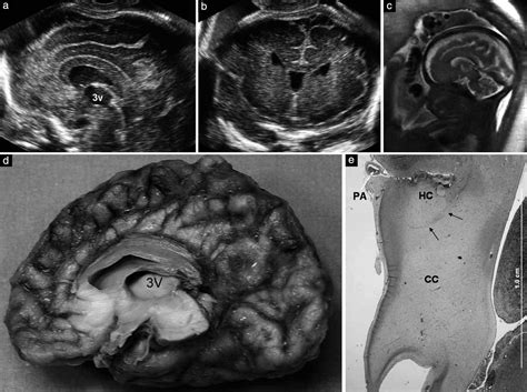 Thick Fetal Corpus Callosum An Ominous Sign Lerman‐sagie 2009