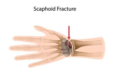 Scaphoid Fracture Archives G4 Physio