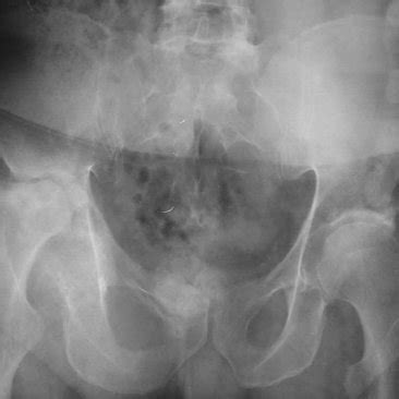 A Plain Radiograph Of The Pelvis And Hips Shows Bilateral Mild